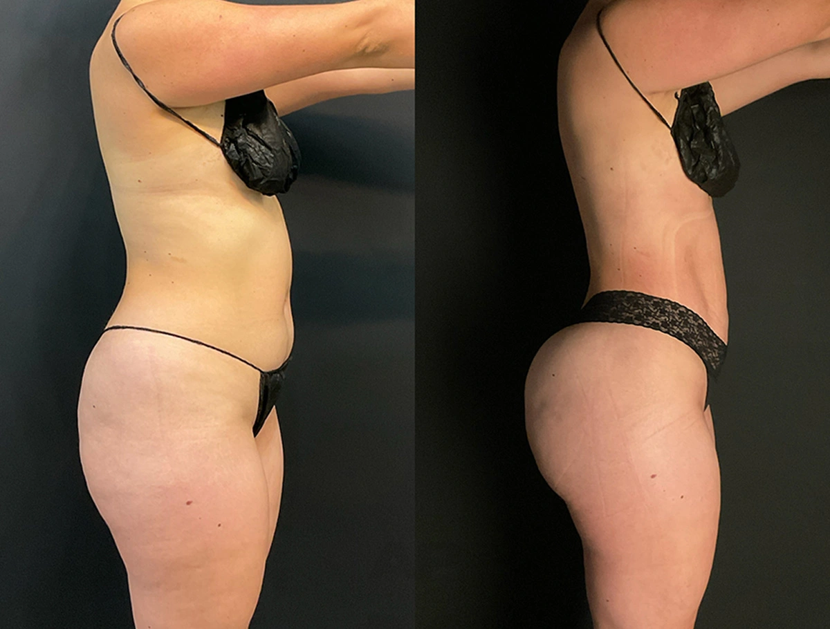 Real Patient Results by Dr. Marshall or Andrew P. Marshall Plastic Surgery serving Beverly Hills & Los Angeles, CA