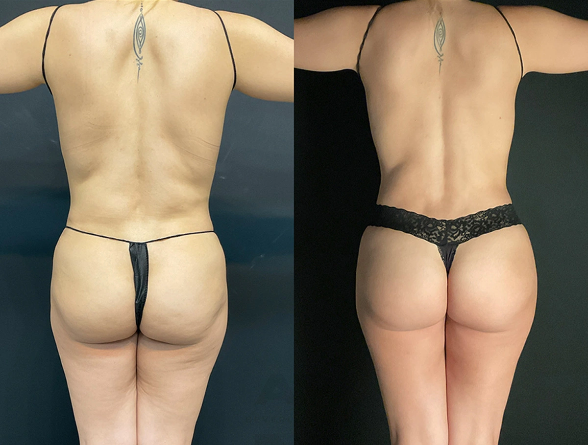 Real Patient Results by Dr. Marshall or Andrew P. Marshall Plastic Surgery serving Beverly Hills & Los Angeles, CA