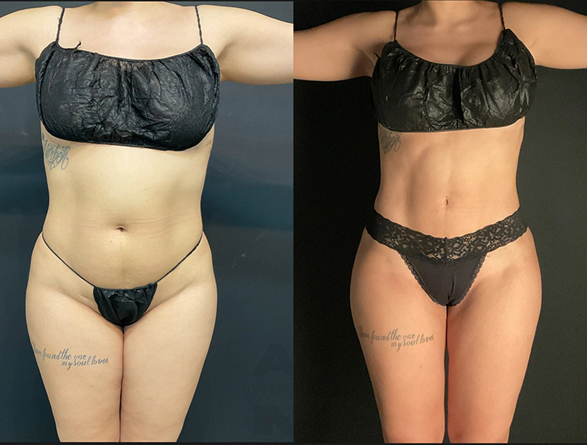 Real Patient Results by Dr. Marshall or Andrew P. Marshall Plastic Surgery serving Beverly Hills & Los Angeles, CA