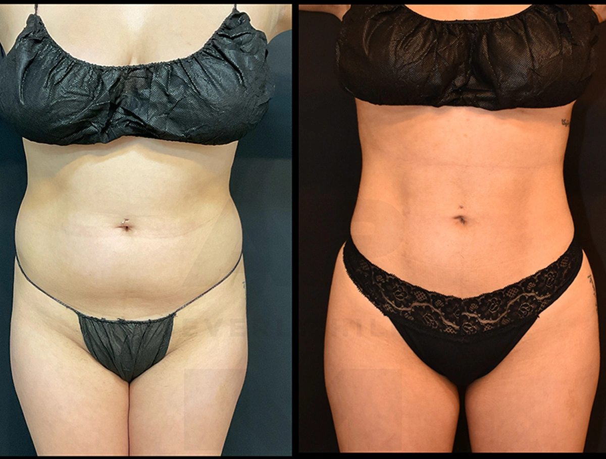 Real Patient Results by Dr. Marshall or Andrew P. Marshall Plastic Surgery serving Beverly Hills & Los Angeles, CA