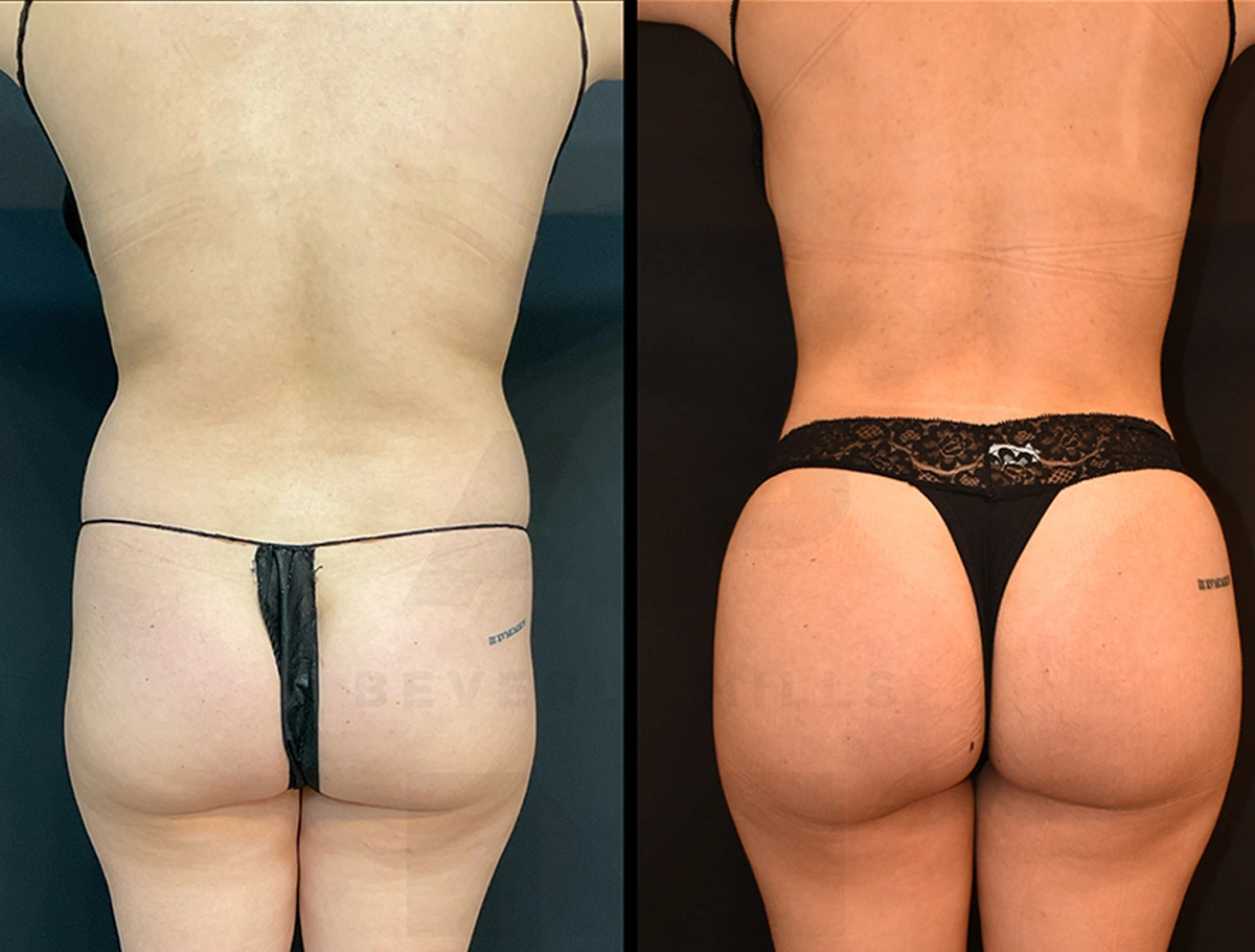 Real Patient Results by Dr. Marshall or Andrew P. Marshall Plastic Surgery serving Beverly Hills & Los Angeles, CA