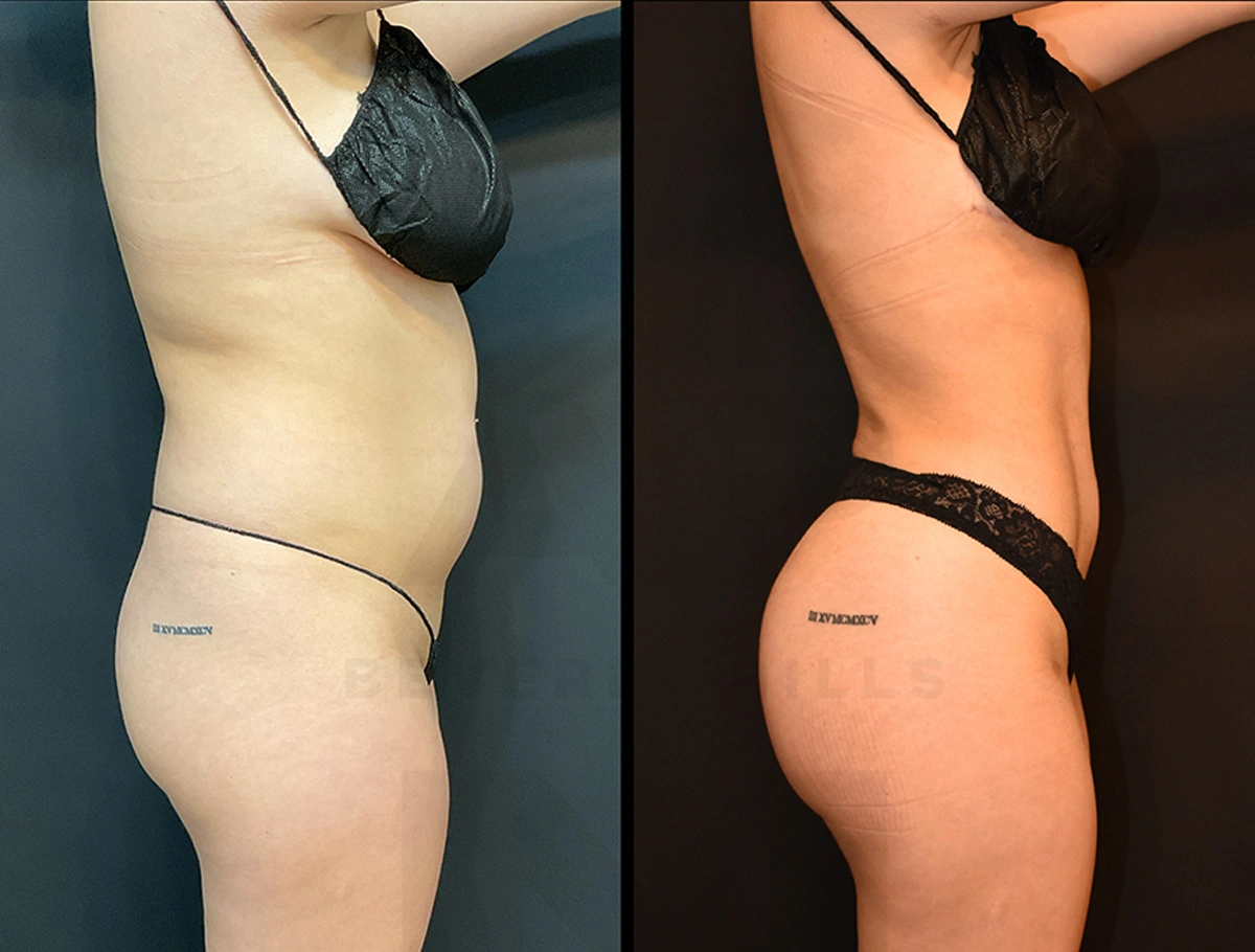 Real Patient Results by Dr. Marshall or Andrew P. Marshall Plastic Surgery serving Beverly Hills & Los Angeles, CA