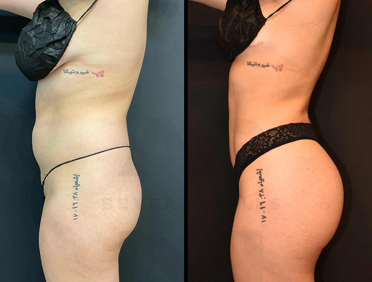 Real Patient Results by Dr. Marshall or Andrew P. Marshall Plastic Surgery serving Beverly Hills & Los Angeles, CA