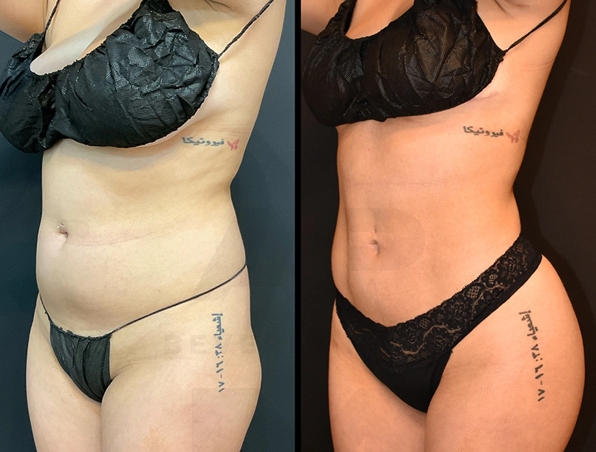 Real Patient Results by Dr. Marshall or Andrew P. Marshall Plastic Surgery serving Beverly Hills & Los Angeles, CA