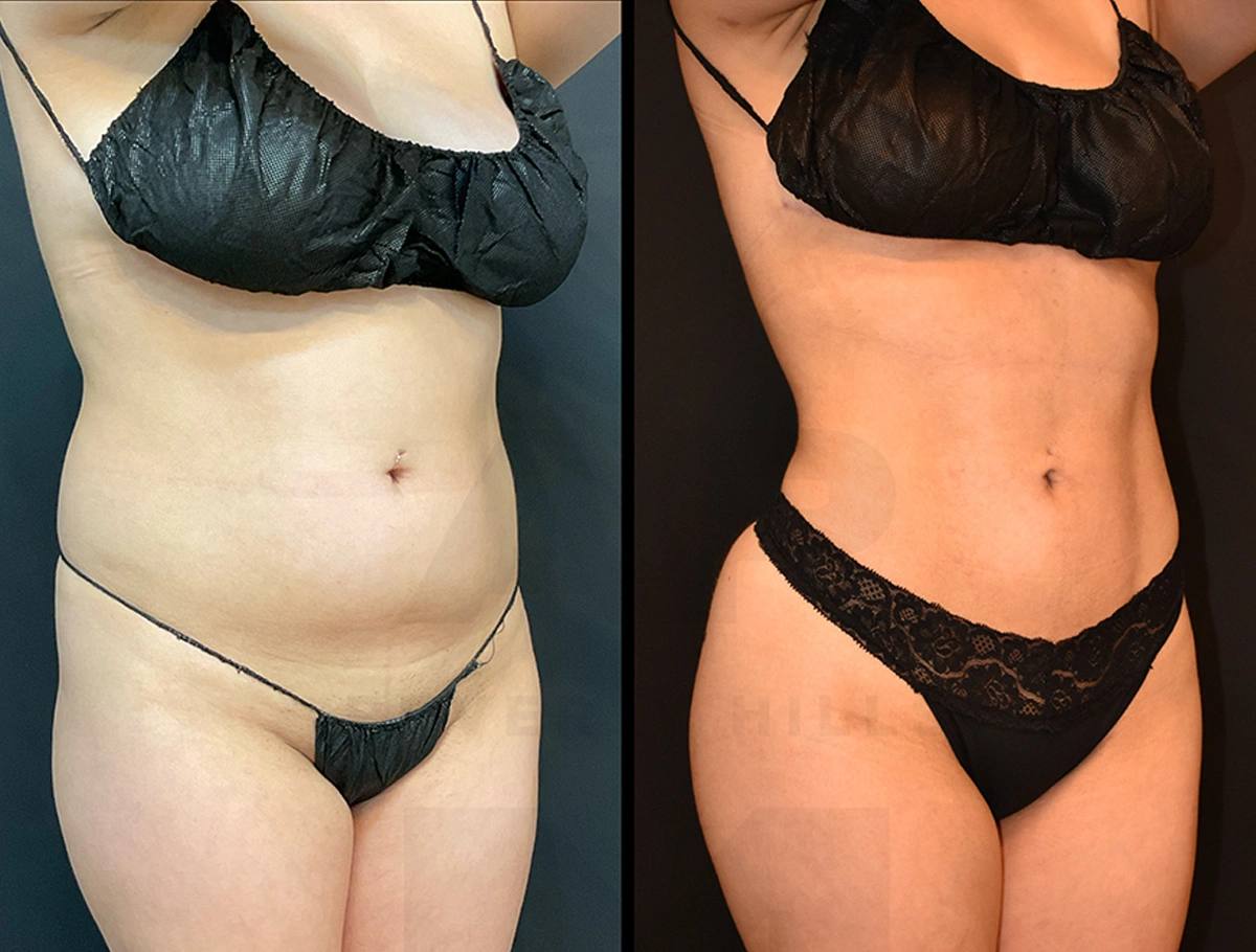 Real Patient Results by Dr. Marshall or Andrew P. Marshall Plastic Surgery serving Beverly Hills & Los Angeles, CA