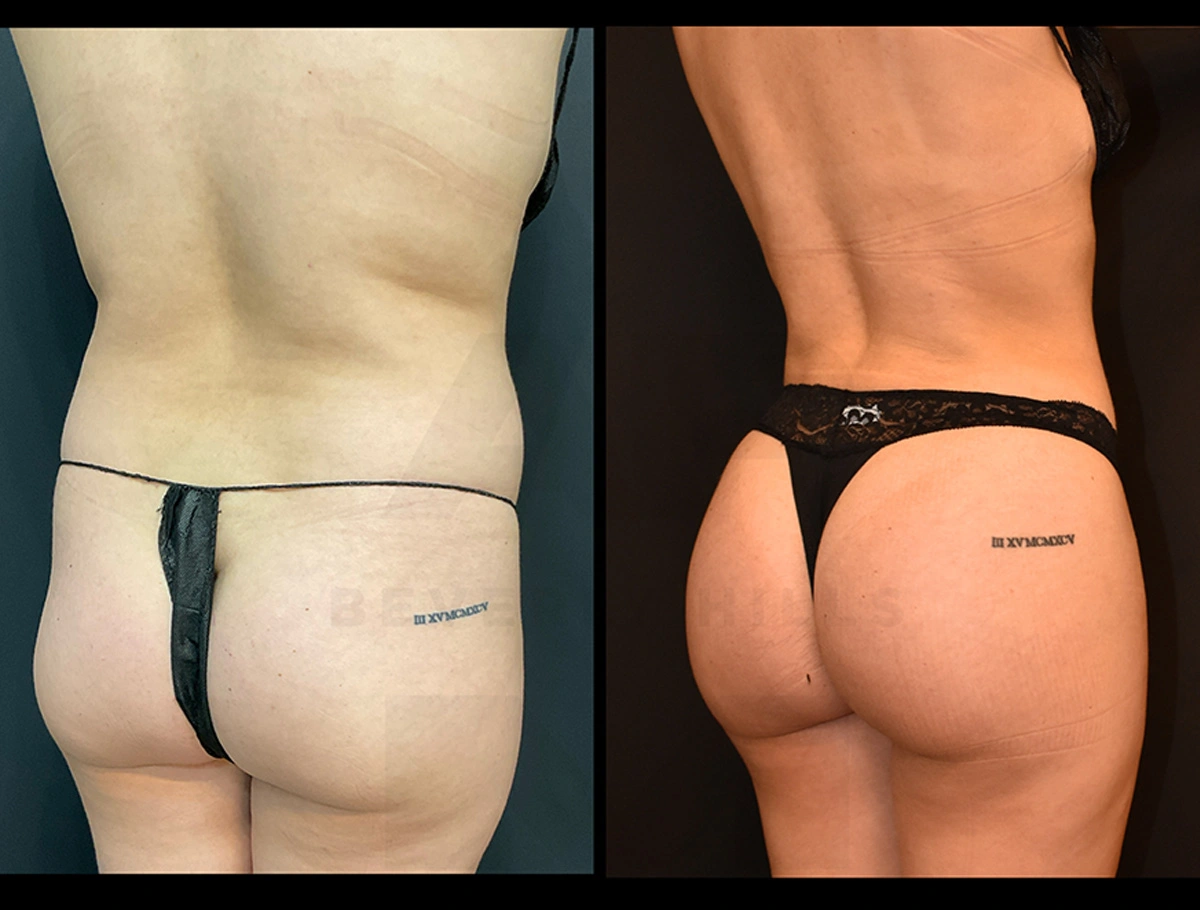 Real Patient Results by Dr. Marshall or Andrew P. Marshall Plastic Surgery serving Beverly Hills & Los Angeles, CA