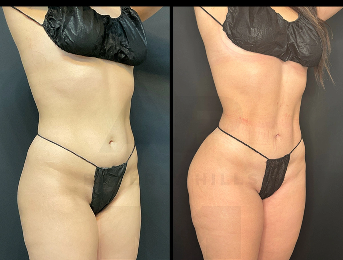 Real Patient Results by Dr. Marshall or Andrew P. Marshall Plastic Surgery serving Beverly Hills & Los Angeles, CA
