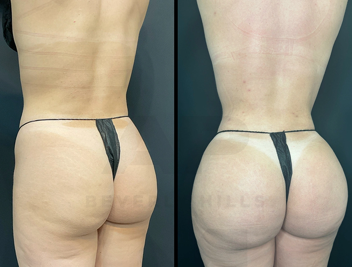 Real Patient Results by Dr. Marshall or Andrew P. Marshall Plastic Surgery serving Beverly Hills & Los Angeles, CA