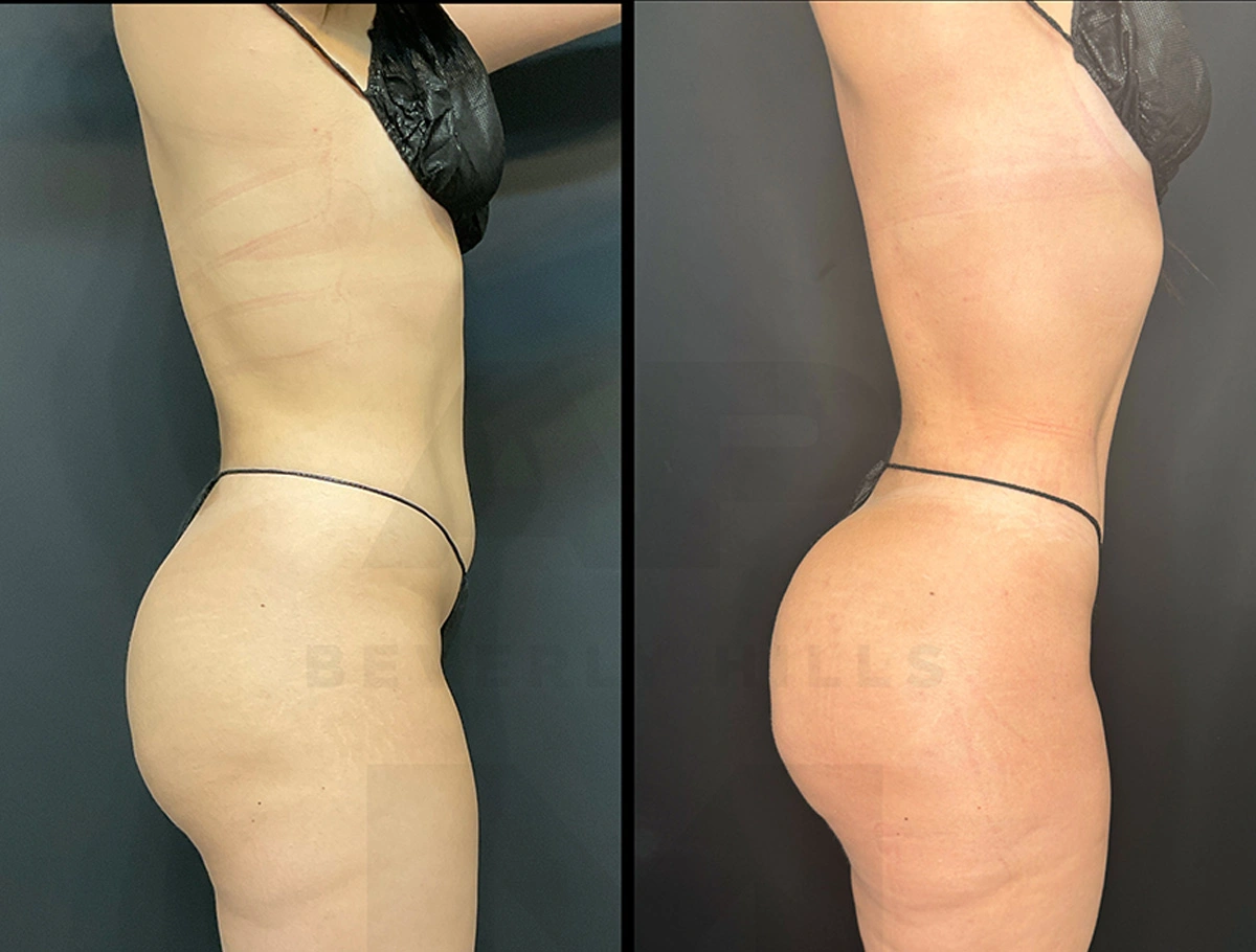 Real Patient Results by Dr. Marshall or Andrew P. Marshall Plastic Surgery serving Beverly Hills & Los Angeles, CA