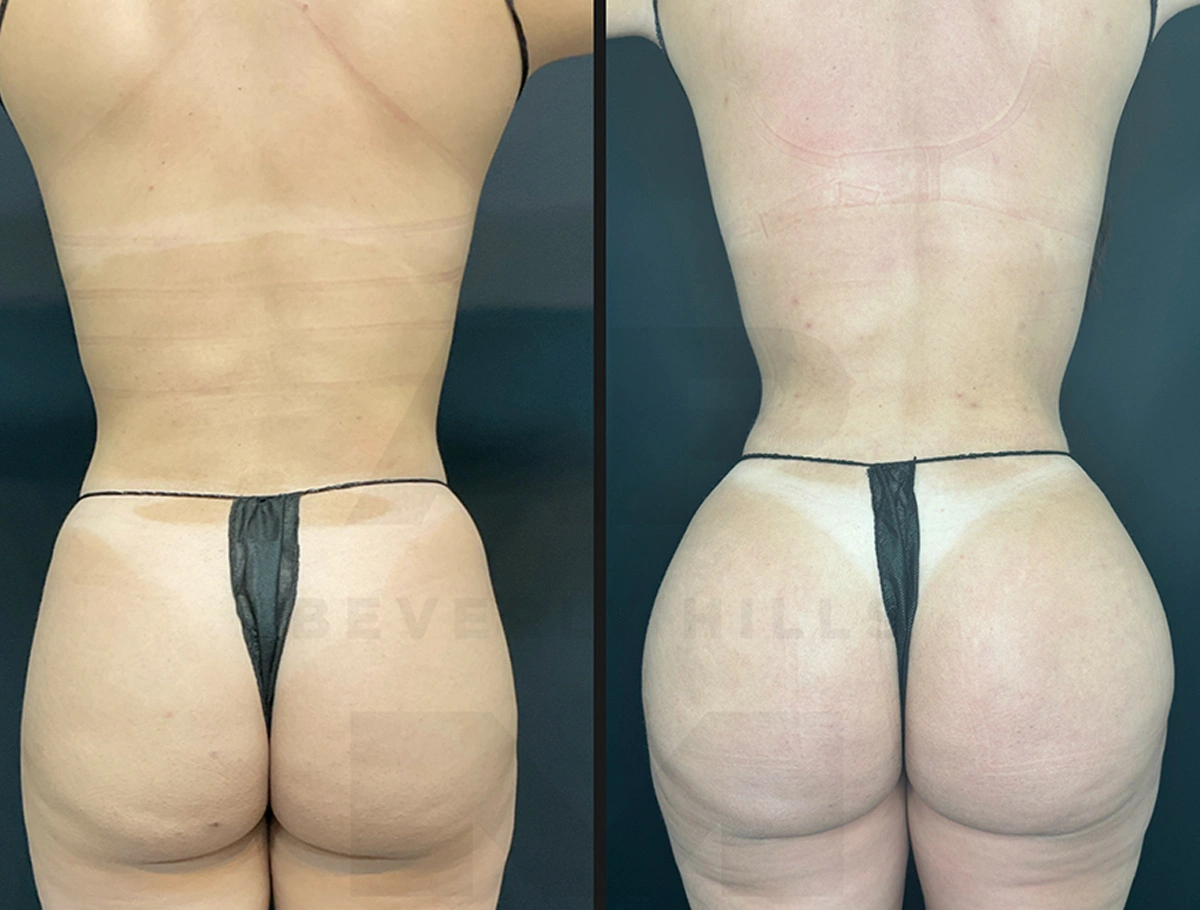 Real Patient Results by Dr. Marshall or Andrew P. Marshall Plastic Surgery serving Beverly Hills & Los Angeles, CA