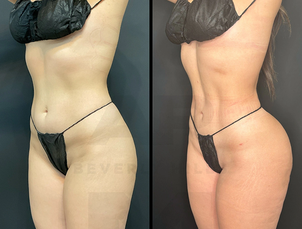 Real Patient Results by Dr. Marshall or Andrew P. Marshall Plastic Surgery serving Beverly Hills & Los Angeles, CA