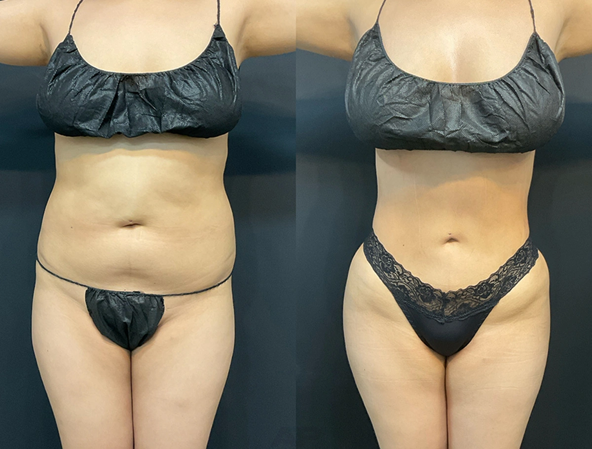 Real Patient Results by Dr. Marshall or Andrew P. Marshall Plastic Surgery serving Beverly Hills & Los Angeles, CA