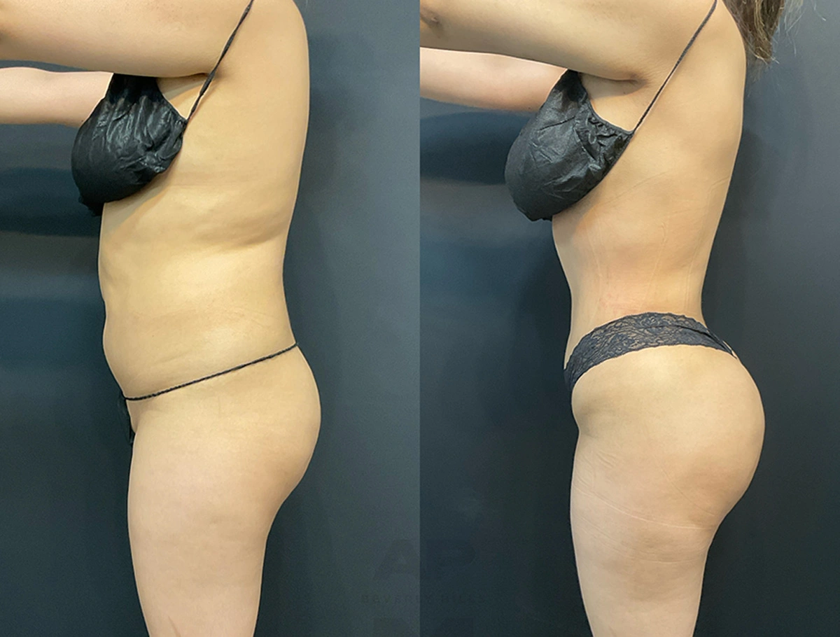 Real Patient Results by Dr. Marshall or Andrew P. Marshall Plastic Surgery serving Beverly Hills & Los Angeles, CA