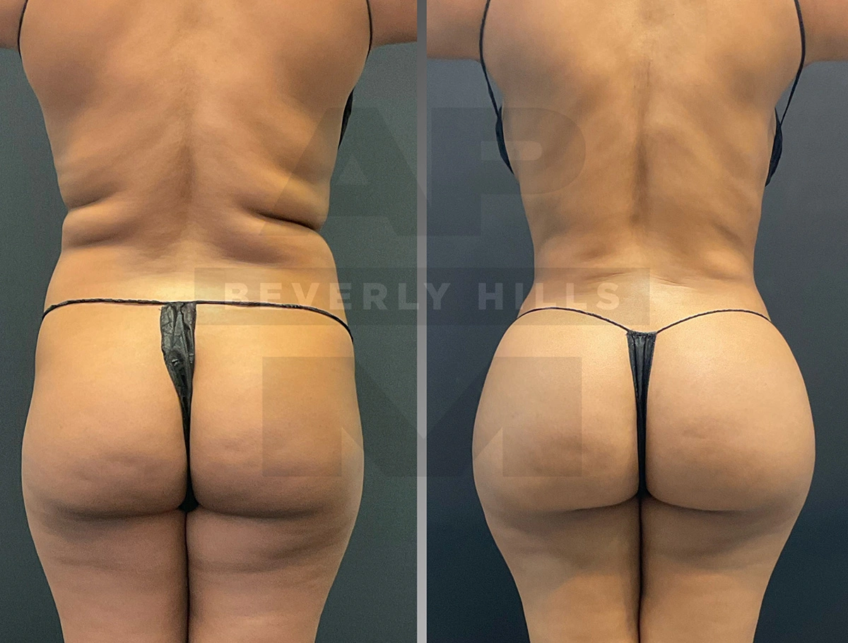 Real Patient Results by Dr. Marshall or Andrew P. Marshall Plastic Surgery serving Beverly Hills & Los Angeles, CA