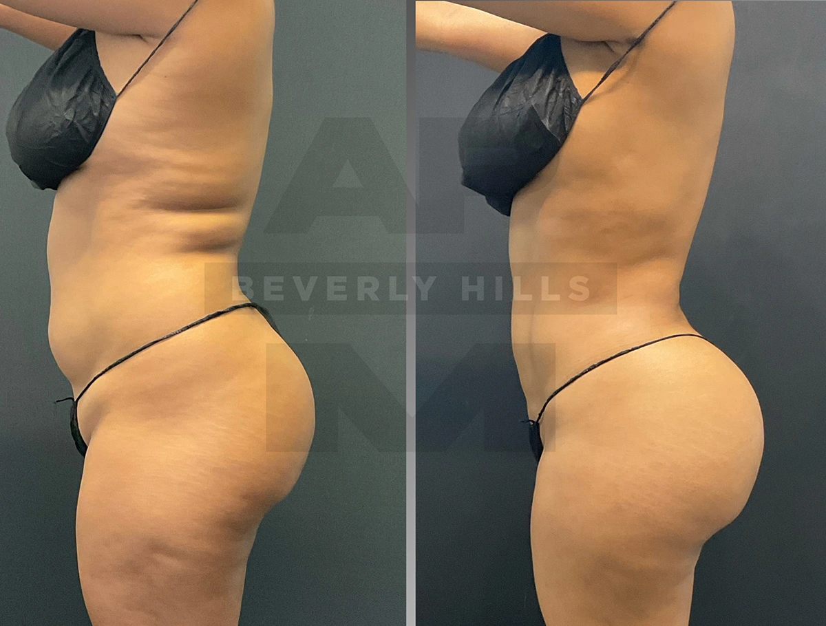 Real Patient Results by Dr. Marshall or Andrew P. Marshall Plastic Surgery serving Beverly Hills & Los Angeles, CA