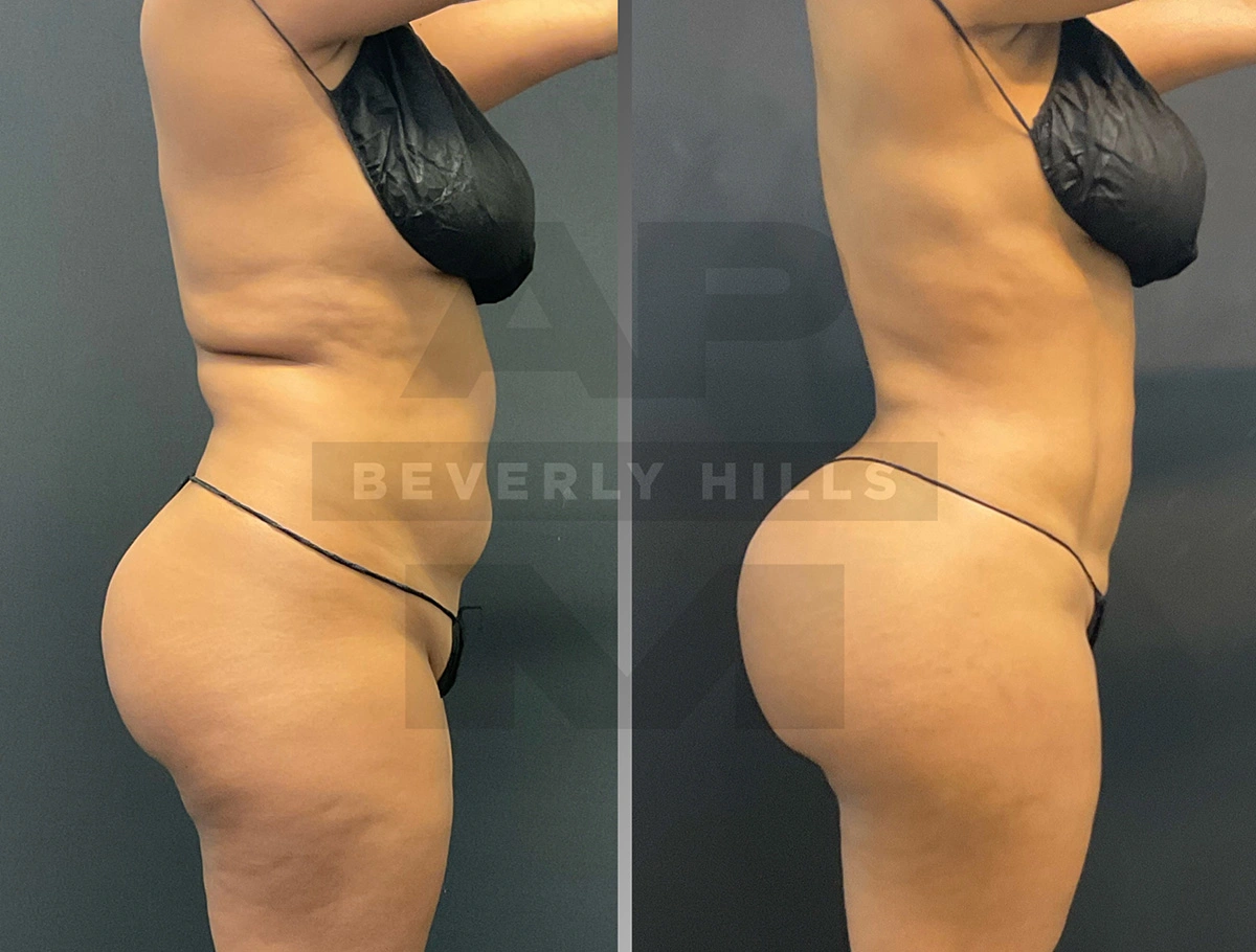 Real Patient Results by Dr. Marshall or Andrew P. Marshall Plastic Surgery serving Beverly Hills & Los Angeles, CA