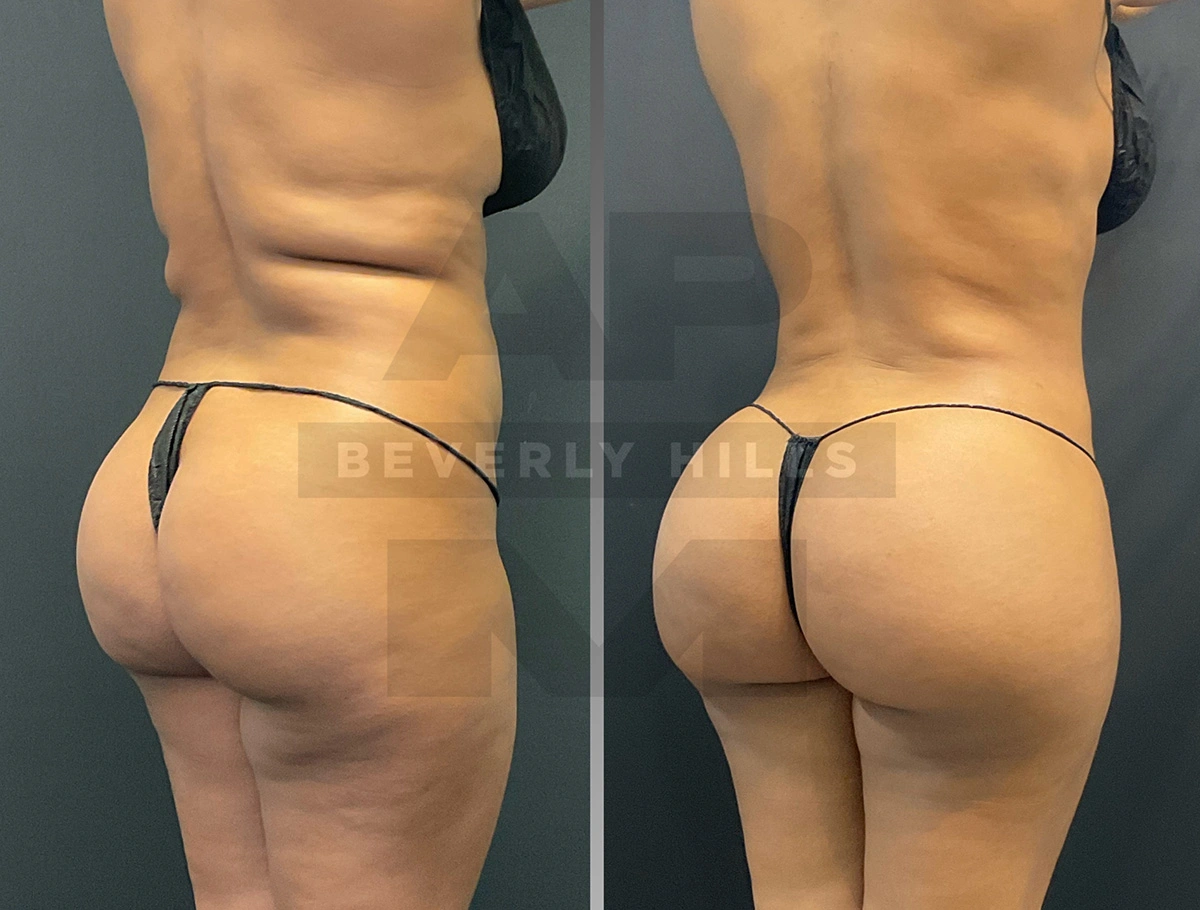 Real Patient Results by Dr. Marshall or Andrew P. Marshall Plastic Surgery serving Beverly Hills & Los Angeles, CA