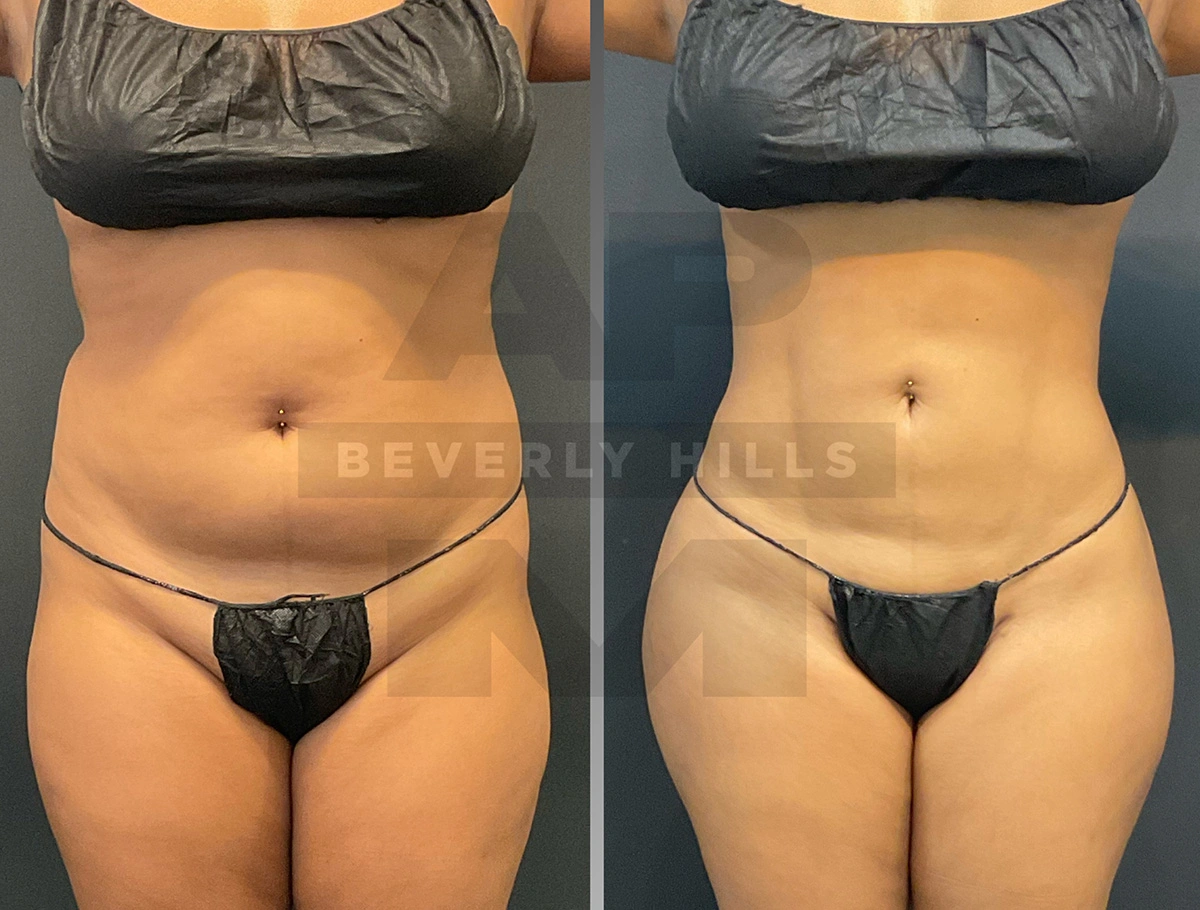 Real Patient Results by Dr. Marshall or Andrew P. Marshall Plastic Surgery serving Beverly Hills & Los Angeles, CA