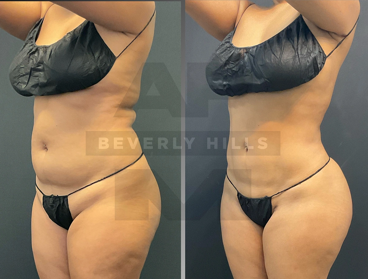 Real Patient Results by Dr. Marshall or Andrew P. Marshall Plastic Surgery serving Beverly Hills & Los Angeles, CA