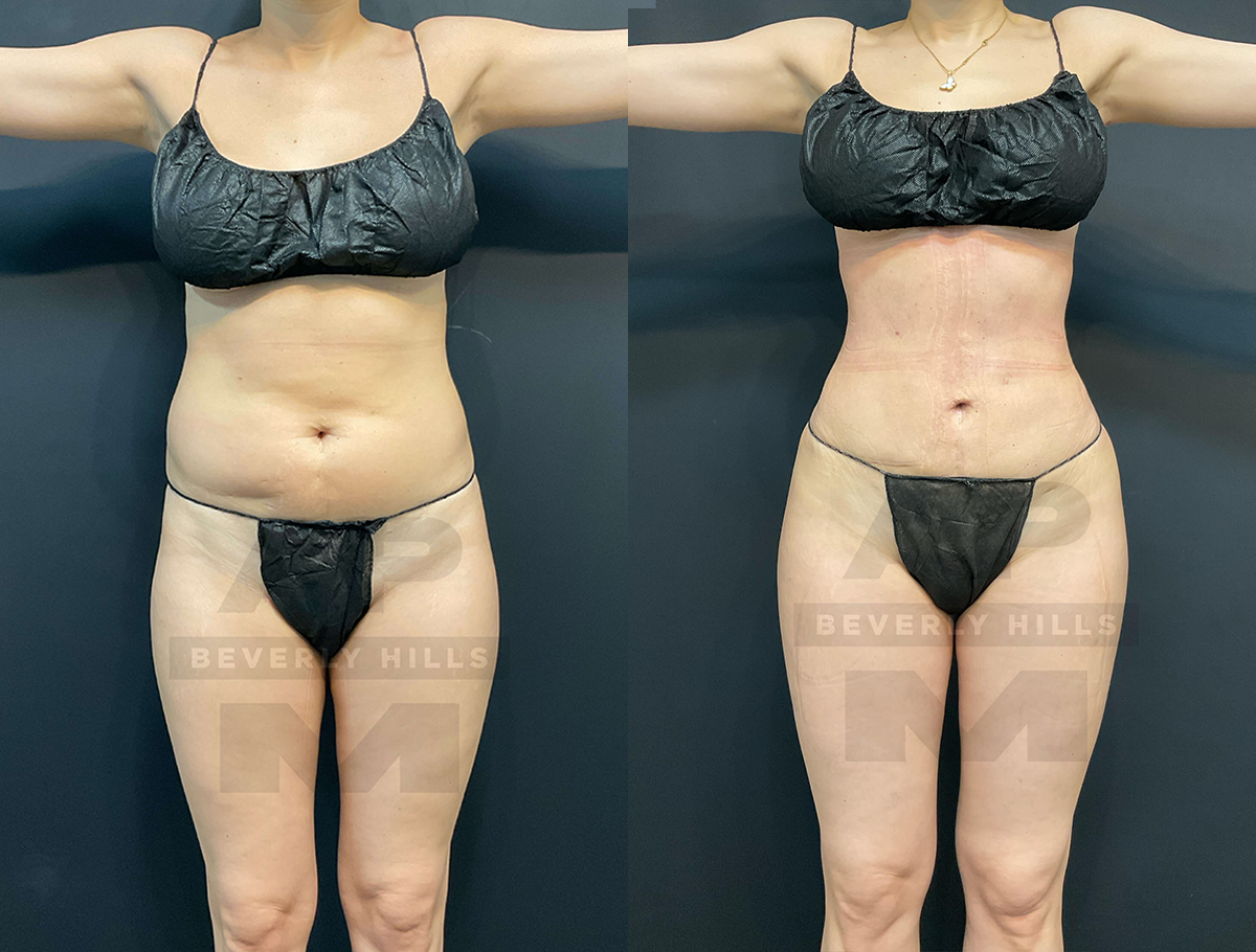 Real Patient Results of Dr. Andre P. Marshall providing Plastic Surgery services to his Beverly Hills & Los Angeles patients.