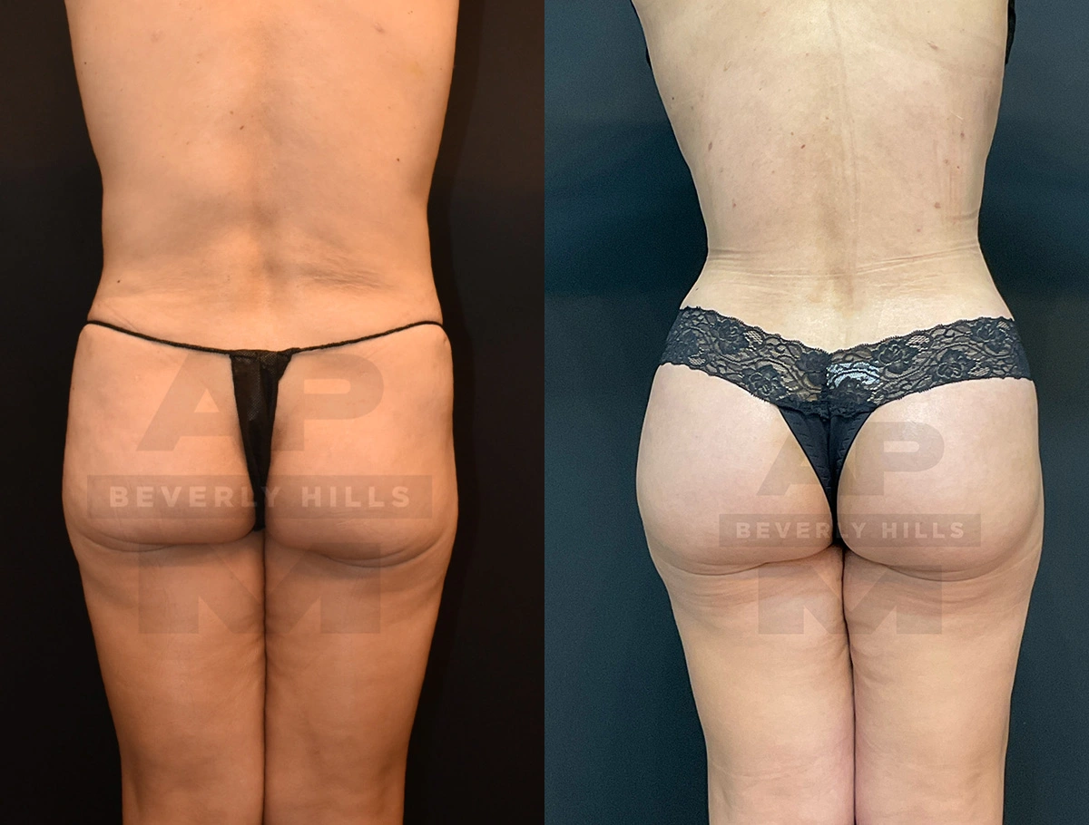 Real Patient Results by Dr. Marshall or Andrew P. Marshall Plastic Surgery serving Beverly Hills & Los Angeles, CA