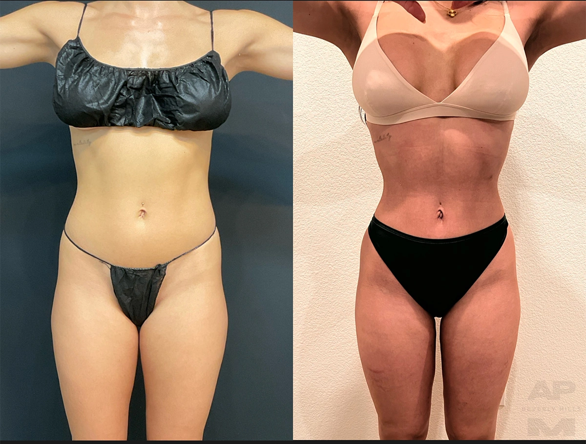 Real Patient Results by Dr. Marshall or Andrew P. Marshall Plastic Surgery serving Beverly Hills & Los Angeles, CA