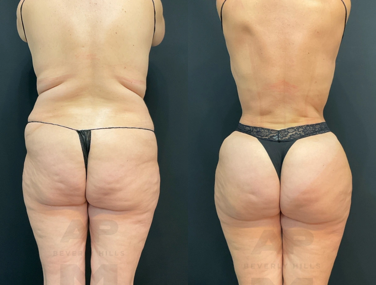 Real Patient Results by Dr. Marshall or Andrew P. Marshall Plastic Surgery serving Beverly Hills & Los Angeles, CA