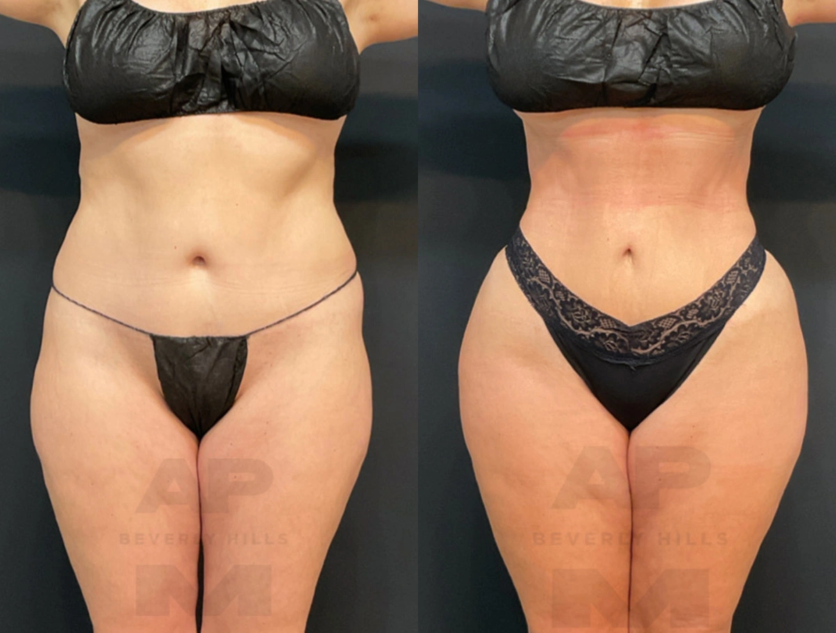 Real Patient Results by Dr. Marshall or Andrew P. Marshall Plastic Surgery serving Beverly Hills & Los Angeles, CA