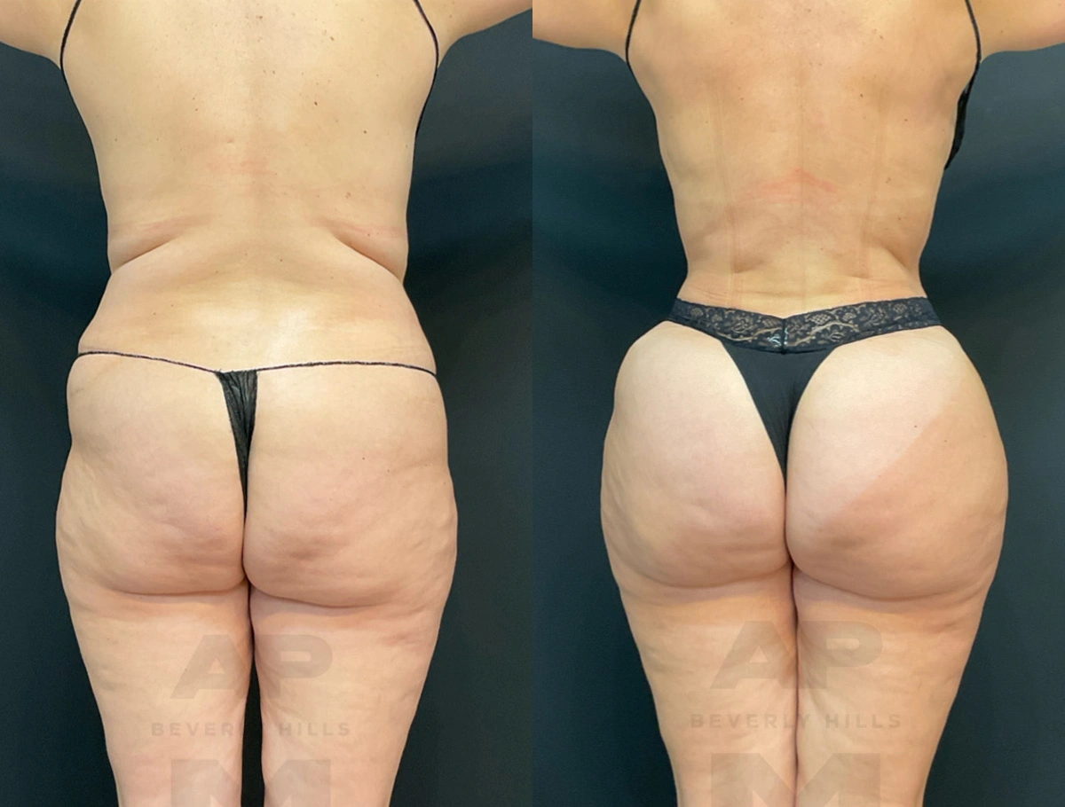 Real Patient Results by Dr. Marshall or Andrew P. Marshall Plastic Surgery serving Beverly Hills & Los Angeles, CA