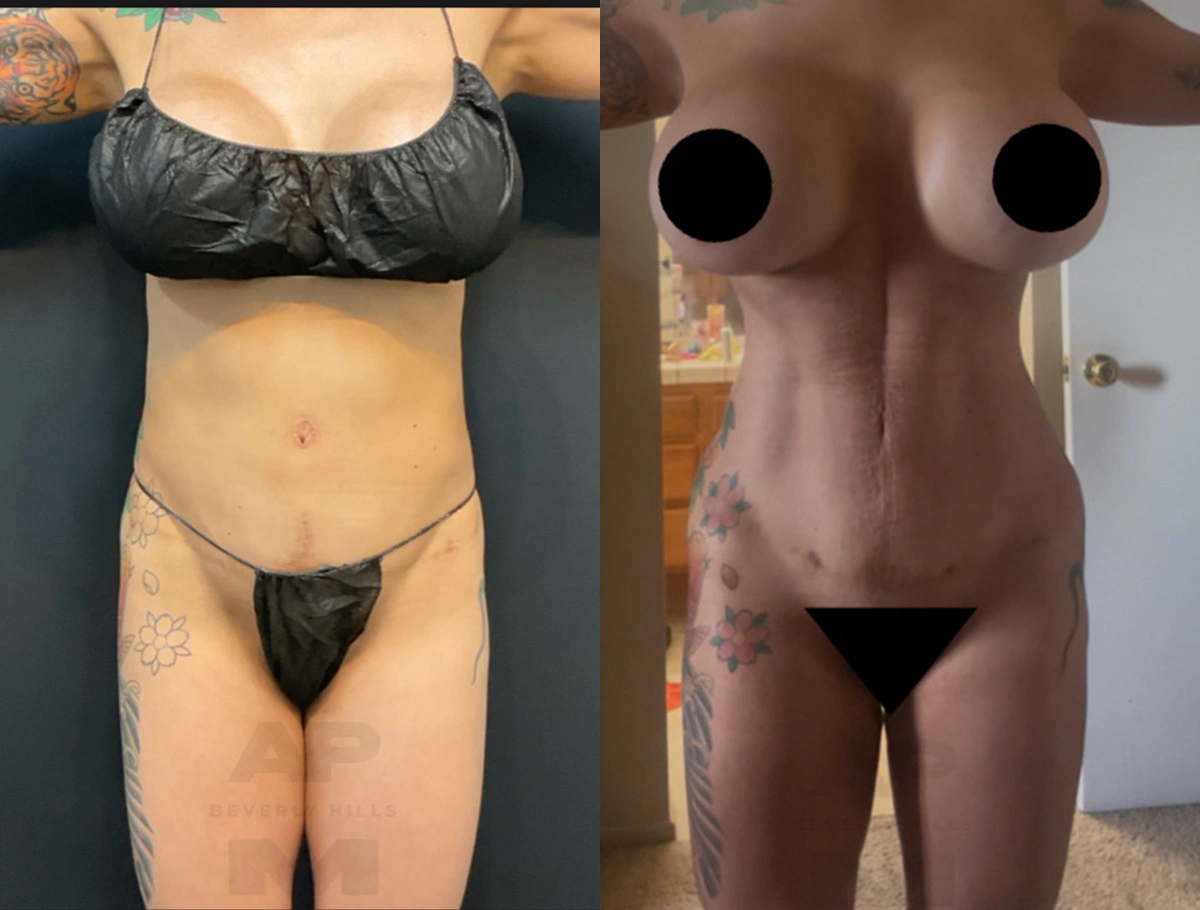 Real Patient Results by Dr. Marshall or Andrew P. Marshall Plastic Surgery serving Beverly Hills & Los Angeles, CA