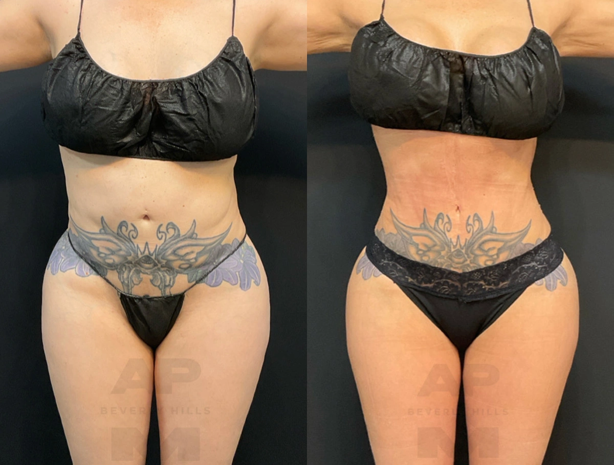 Real Patient Results by Dr. Marshall or Andrew P. Marshall Plastic Surgery serving Beverly Hills & Los Angeles, CA