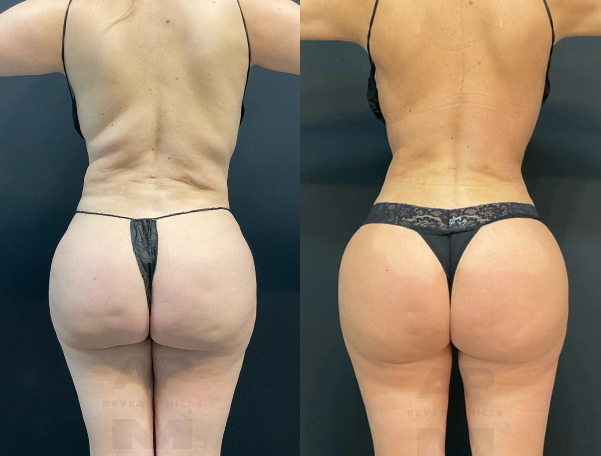 Real Patient Results by Dr. Marshall or Andrew P. Marshall Plastic Surgery serving Beverly Hills & Los Angeles, CA