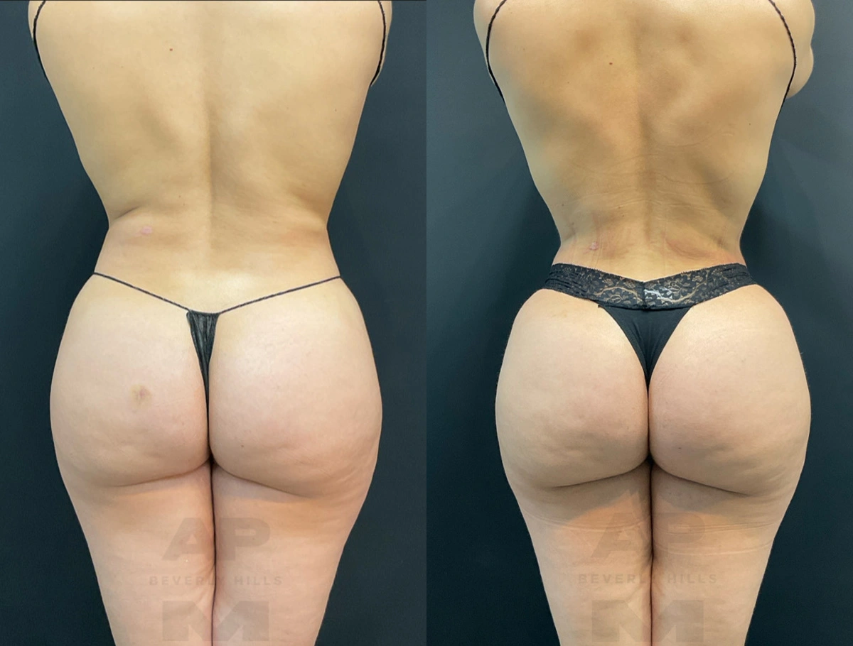 Real Patient Results by Dr. Marshall or Andrew P. Marshall Plastic Surgery serving Beverly Hills & Los Angeles, CA