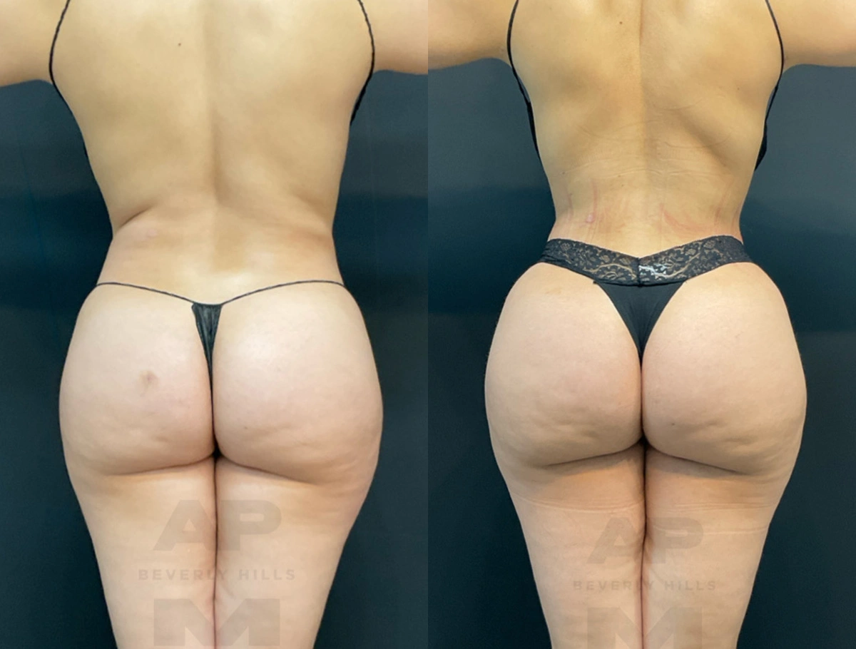 Real Patient Results by Dr. Marshall or Andrew P. Marshall Plastic Surgery serving Beverly Hills & Los Angeles, CA