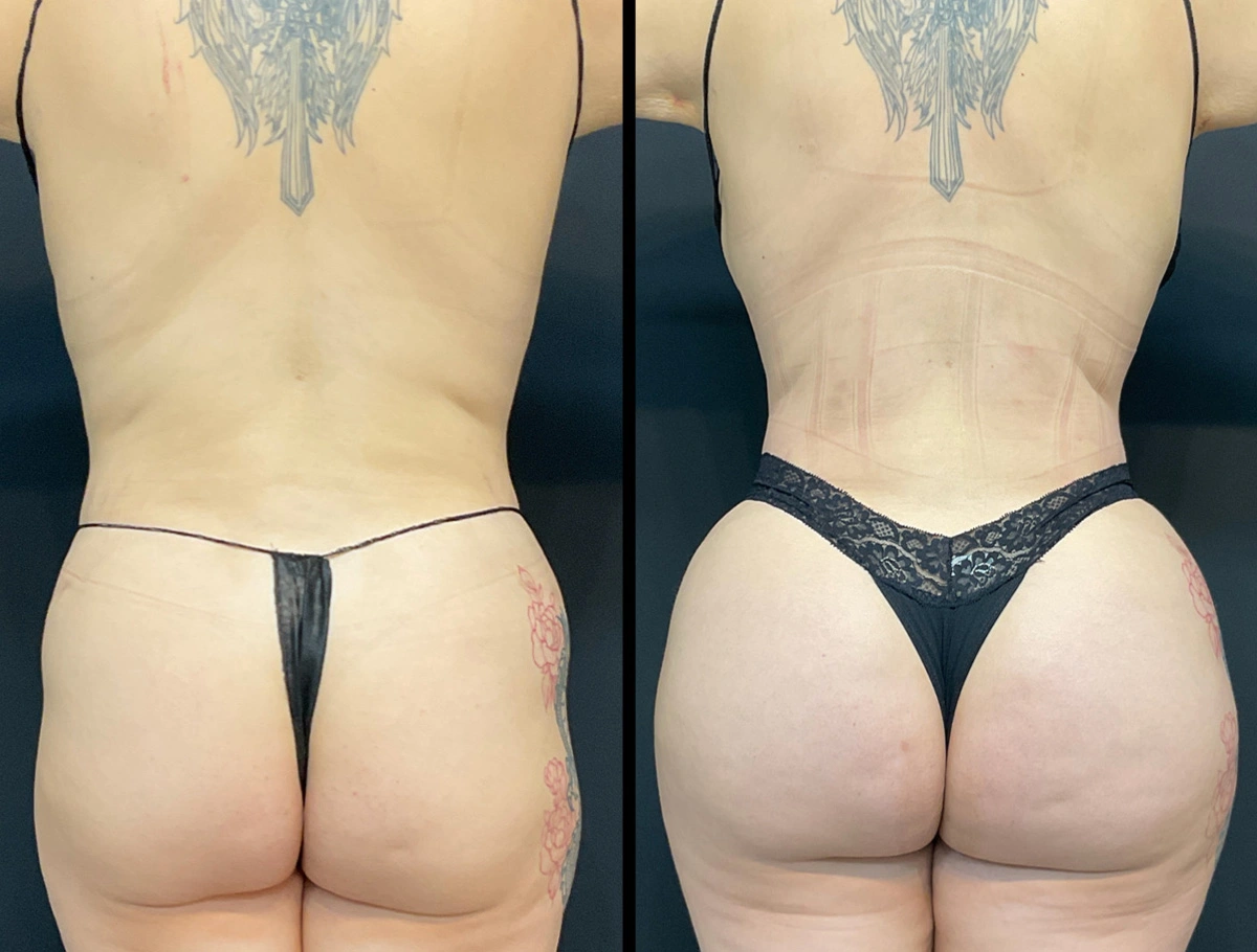 Real Patient Results by Dr. Marshall or Andrew P. Marshall Plastic Surgery serving Beverly Hills & Los Angeles, CA