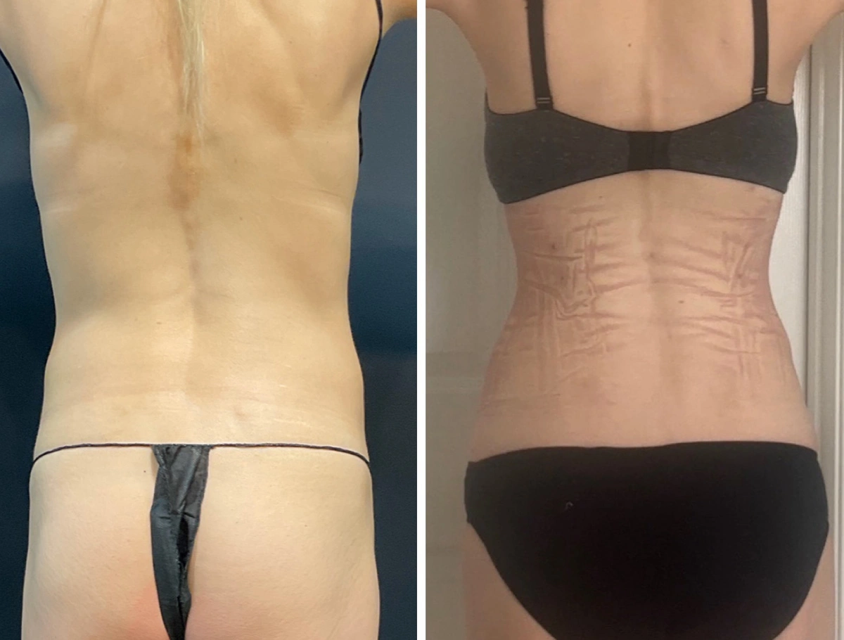 Real Patient Results by Dr. Marshall or Andrew P. Marshall Plastic Surgery serving Beverly Hills & Los Angeles, CA