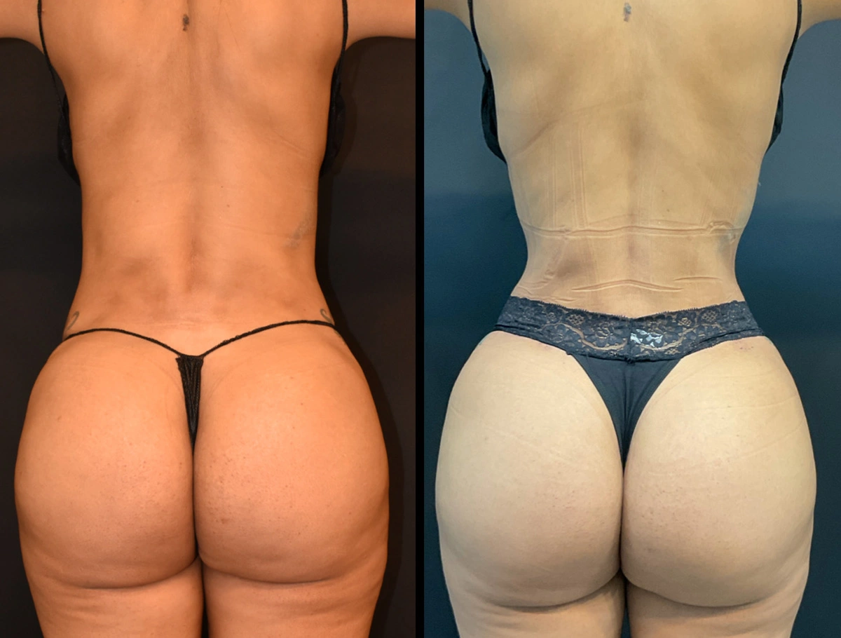 Real Patient Results by Dr. Marshall or Andrew P. Marshall Plastic Surgery serving Beverly Hills & Los Angeles, CA