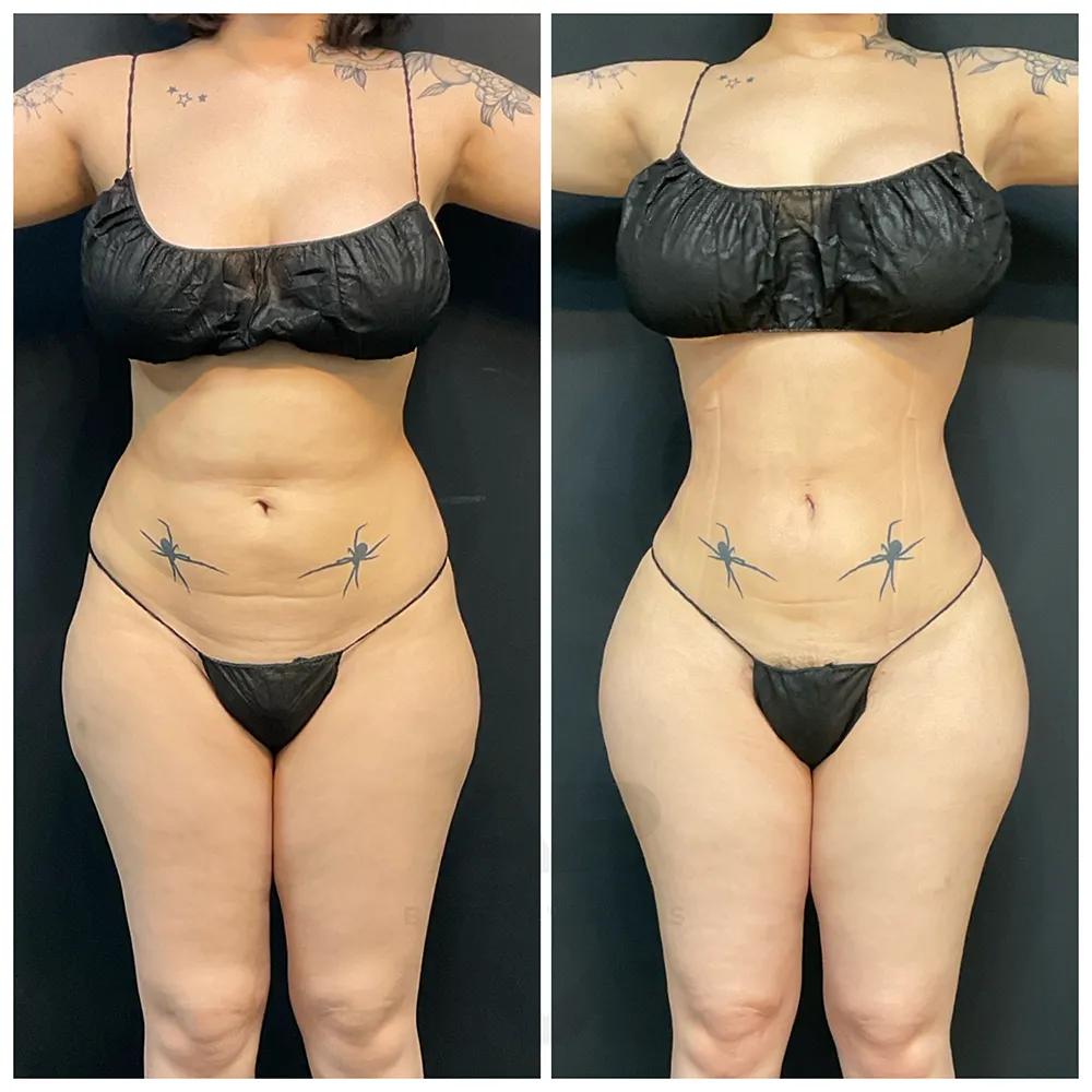 Rib Remodeling_AR_IMG_6236
