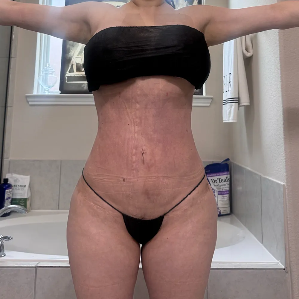 Rib Remodeling_BR_after front