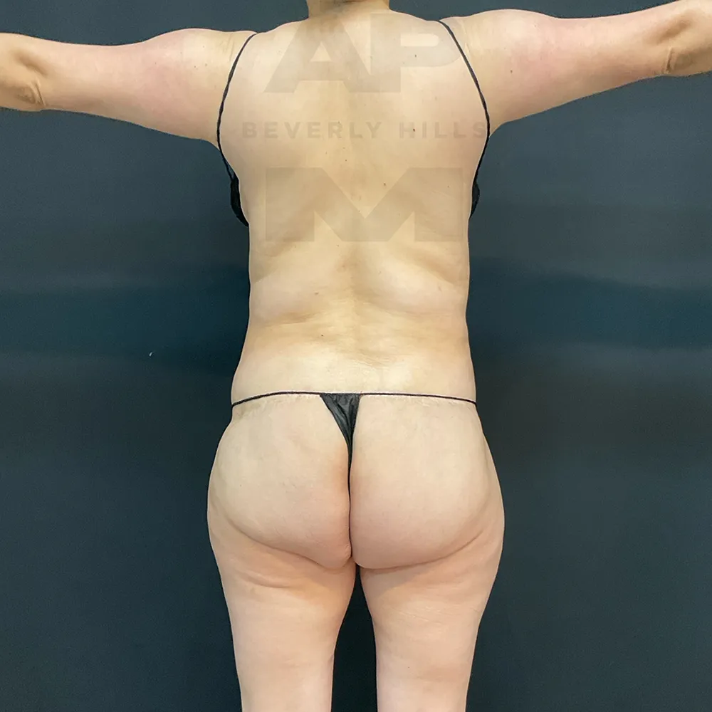 Rib Remodeling_BR_before back