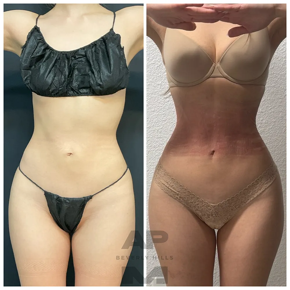 Rib Remodeling_SR_IMG_5465