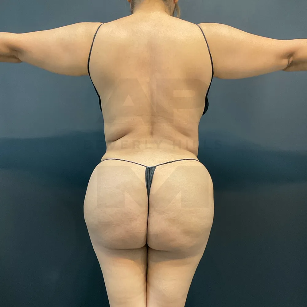 aveli_ED_Back before_