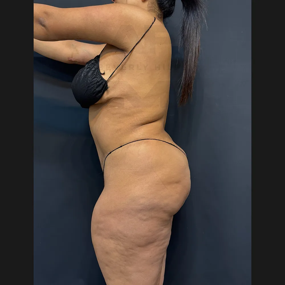 aveli_HM_left before