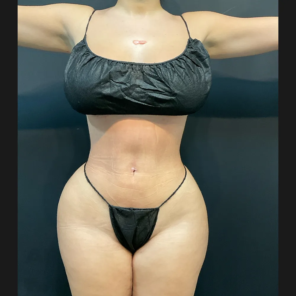 bbl-SM_Front after_