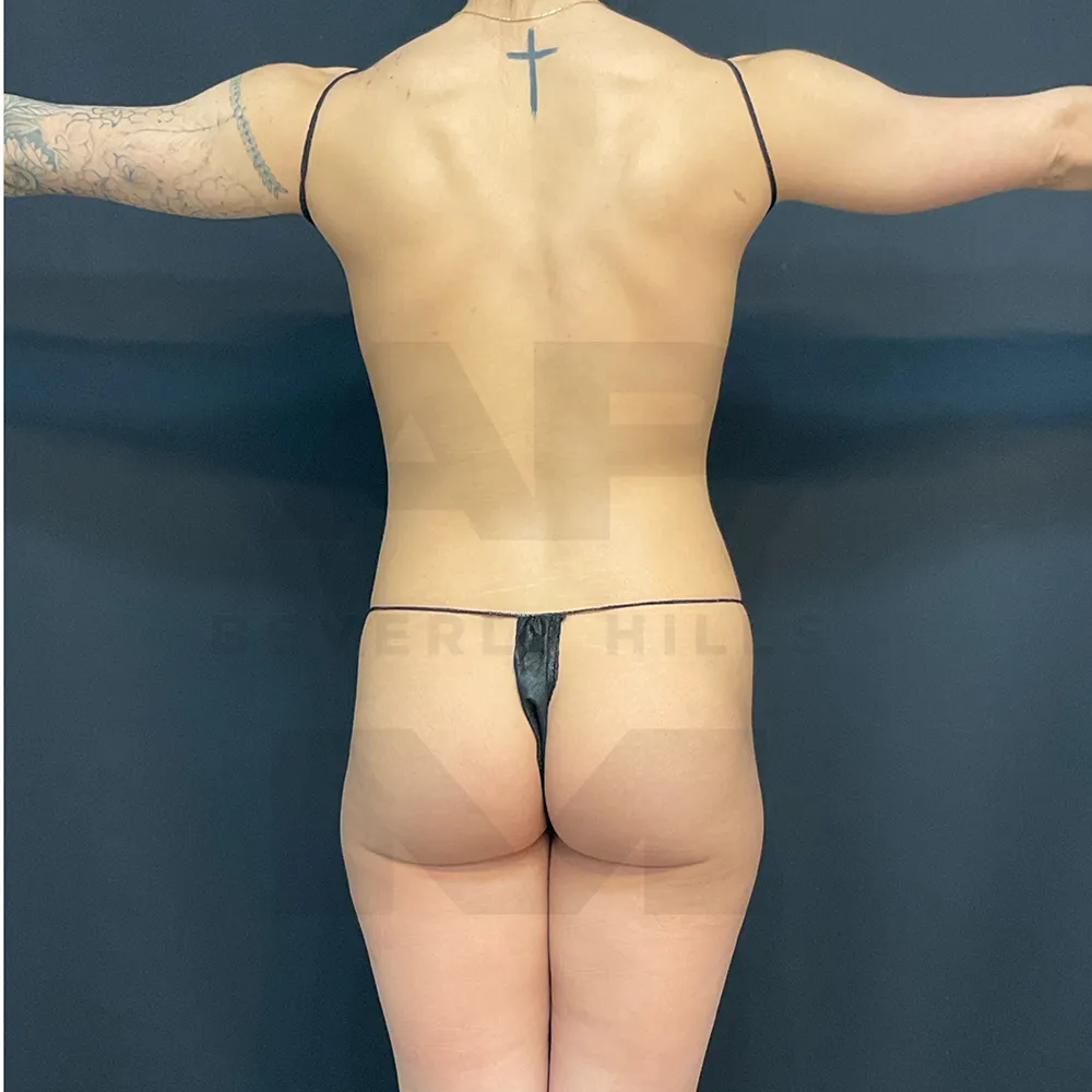 lipo_MB_IMG_6002