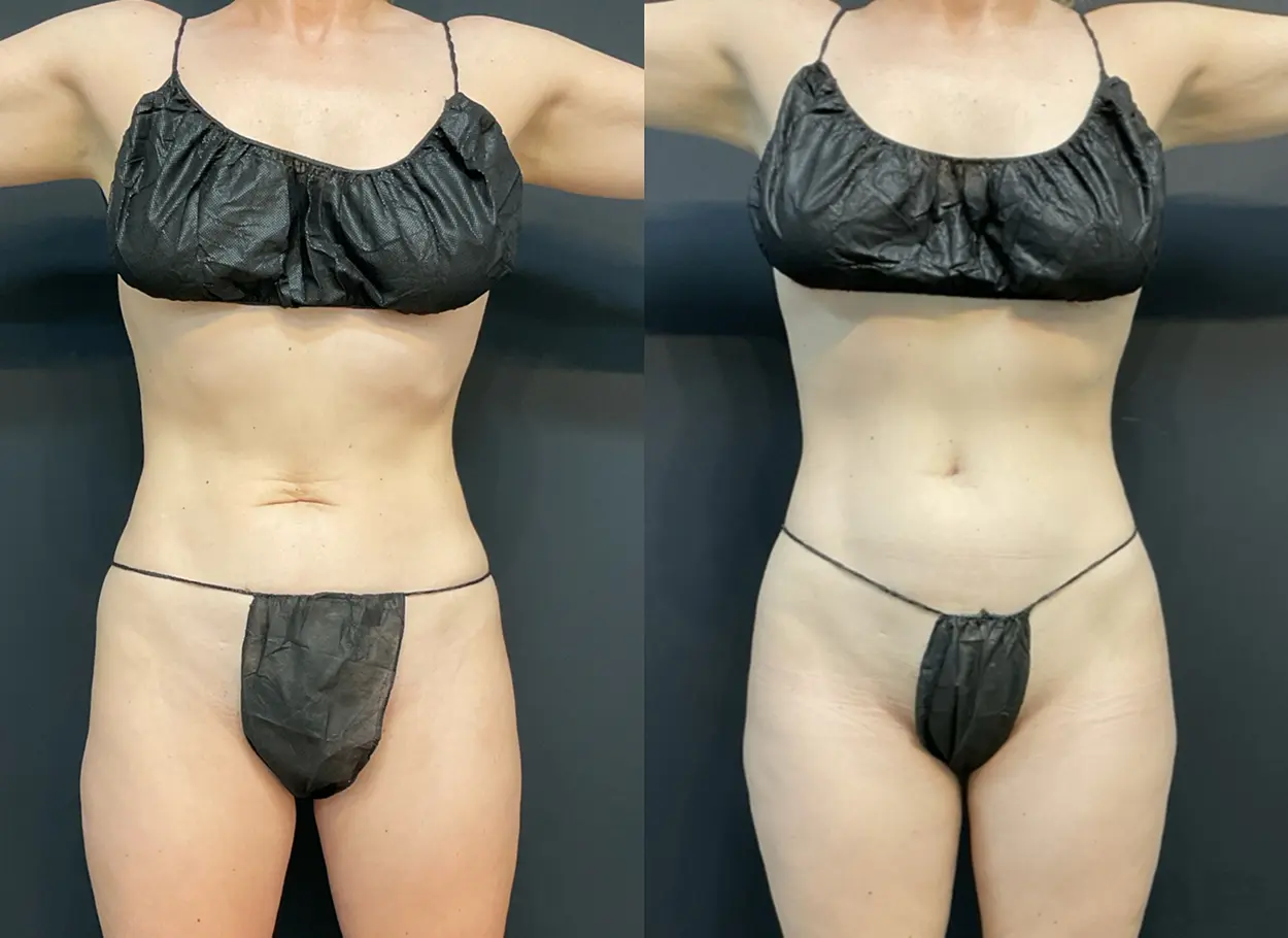 reverse-tummy-tuck-01