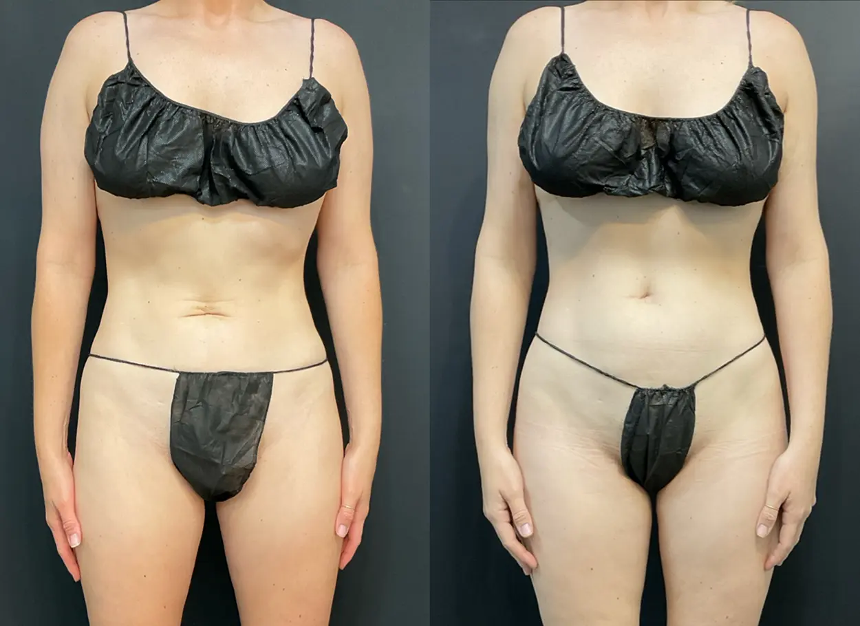 reverse-tummy-tuck-02