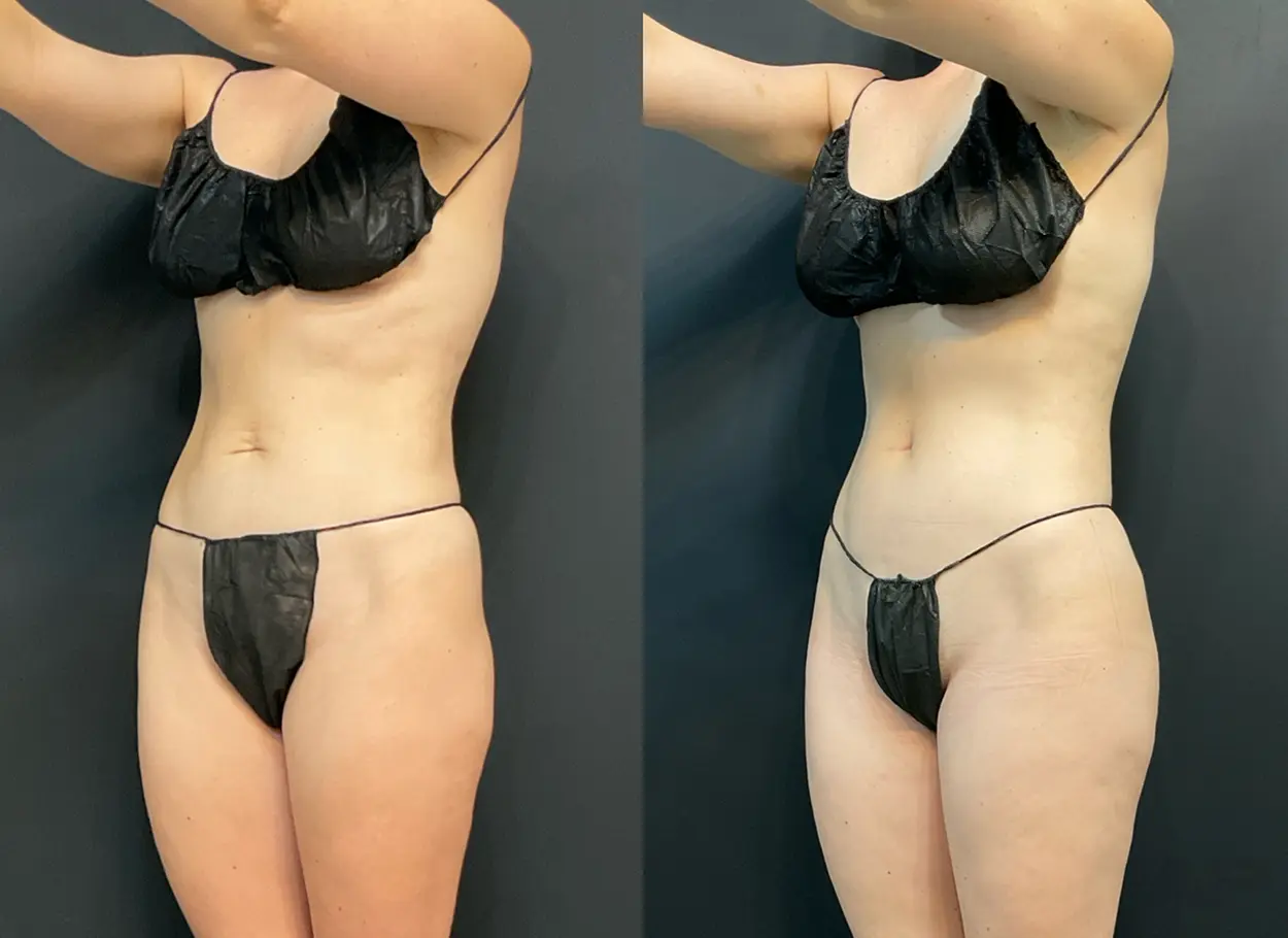 reverse-tummy-tuck-03