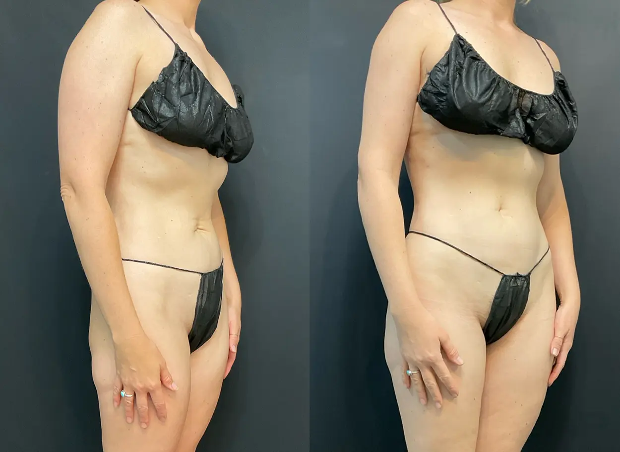 reverse-tummy-tuck-04