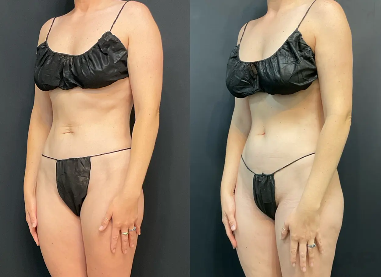 reverse-tummy-tuck-05